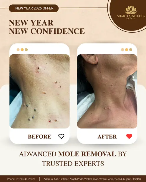 MOLE REMOVAL - SHANTI AESTHETIC — Shanti Aesthetic Clinic